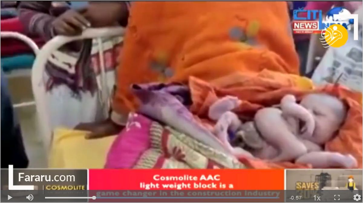 ببینید: تولد نوزاد چهار دست و پا در هند تعجب همه را برانگیخت