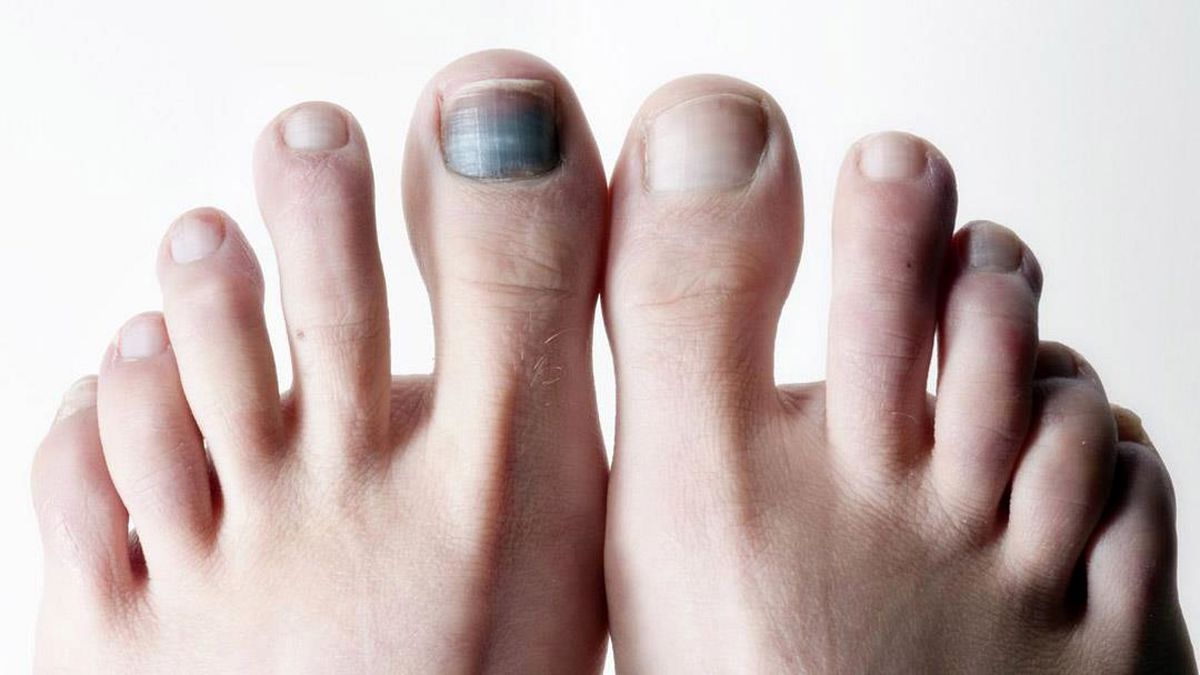 علت سیاه شدن ناخن پا + راه‌های درمان